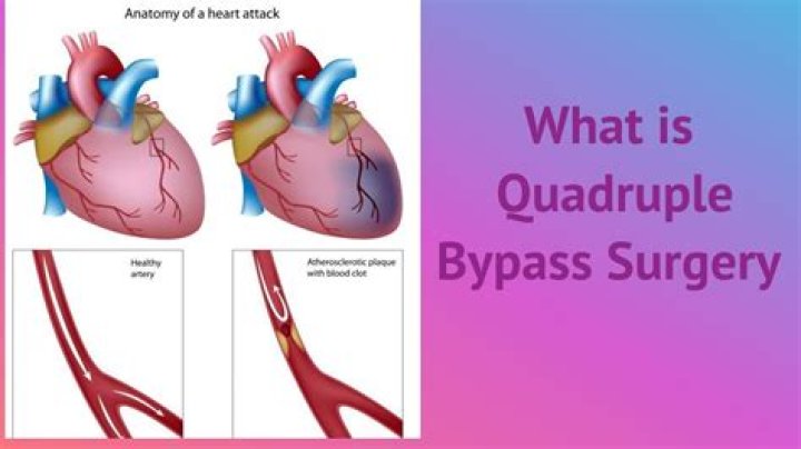 Underwent Quadruple Bypass Surgery To Lose 1 Pounds!