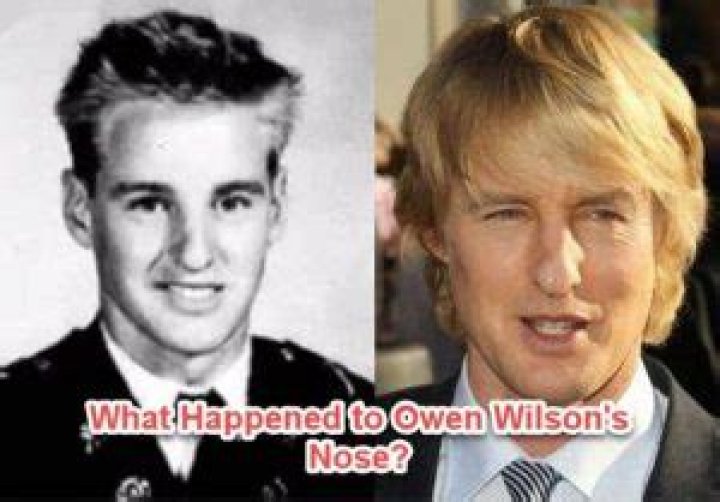 What Happened to Owen Wilson’s Nose?
